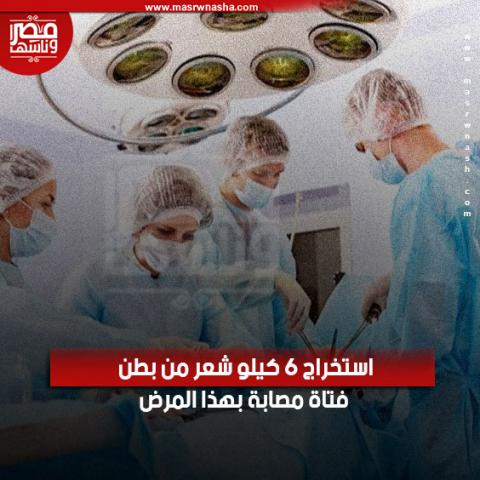 استخراج 6 كيلو شعر من بطن فتاة 