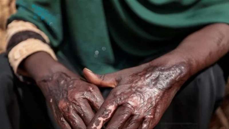 إمراة سودانية من ضحايا انتهاكات الدعم السريع في الجنين